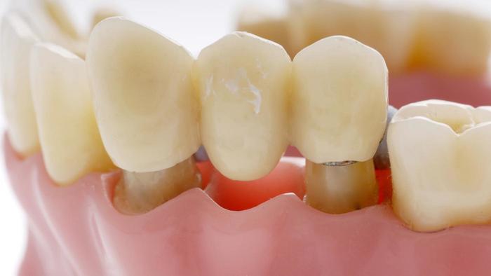 dental bridges eb4a751402fa3782